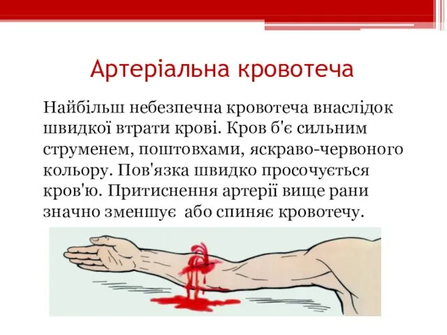 Артеріальна кровотеча Найбільш небезпечна кровотеча внаслідок швидкої втрати крові. Кров