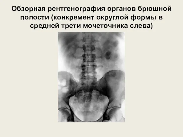 Обзорная рентгенография органов брюшной полости (конкремент округлой формы в средней трети мочеточника слева)