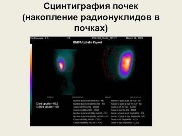 Сцинтиграфия почек (накопление радионуклидов в почках)