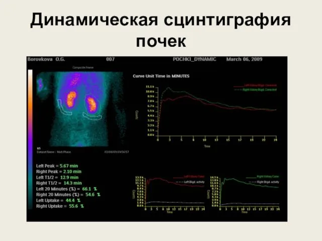 Динамическая сцинтиграфия почек