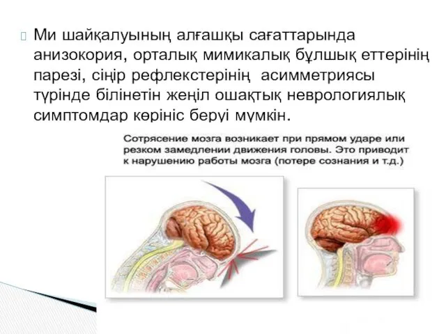 Ми шайқалуының алғашқы сағаттарында анизокория, орталық мимикалық бұлшық еттерінің парезі,