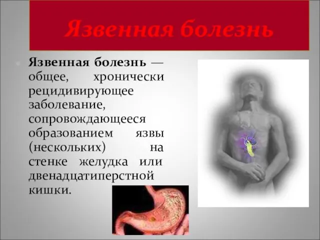 Язвенная болезнь Язвенная болезнь —общее, хронически рецидивирующее заболевание, сопровождающееся образованием