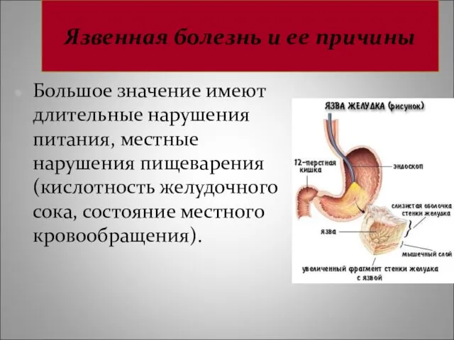 Язвенная болезнь и ее причины Большое значение имеют длительные нарушения