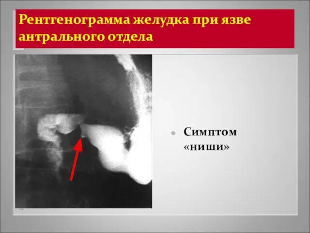 Рентгенограмма желудка при язве антрального отдела Симптом «ниши»