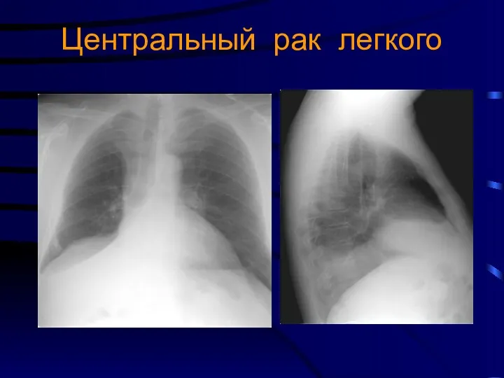 Центральный рак легкого