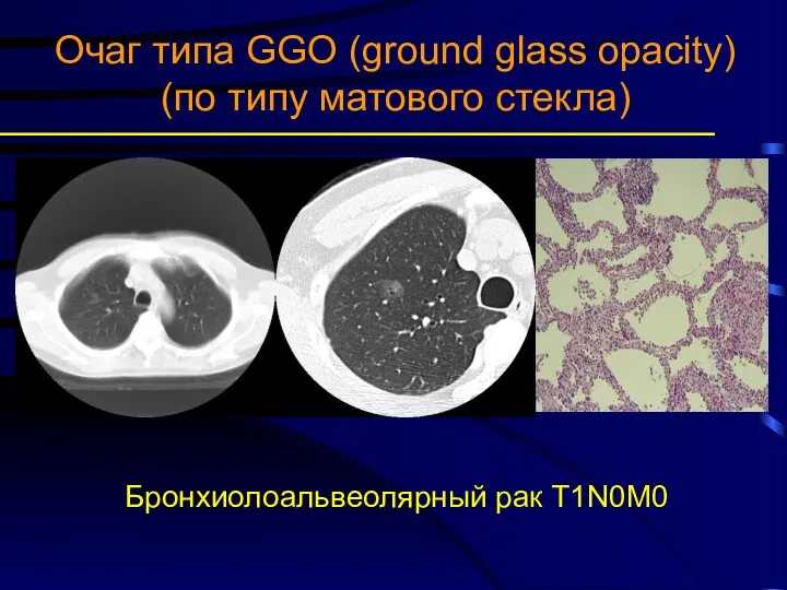 Очаг типа GGO (ground glass opacity) (по типу матового стекла) Бронхиолоальвеолярный рак T1N0M0