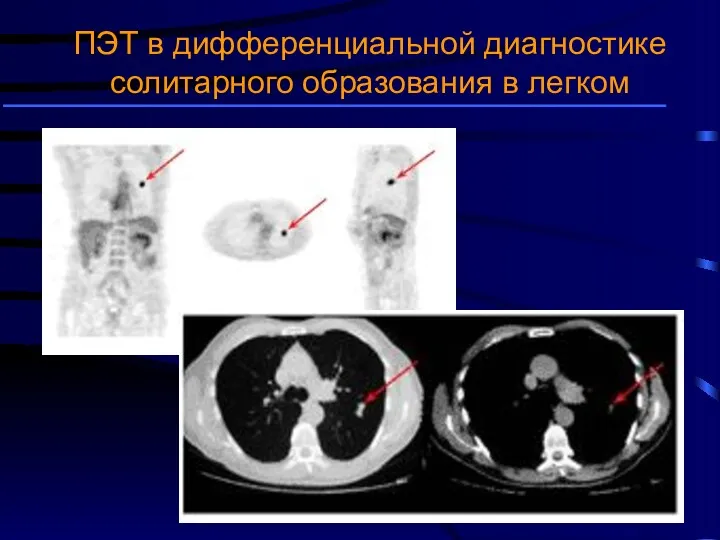 ПЭТ в дифференциальной диагностике солитарного образования в легком