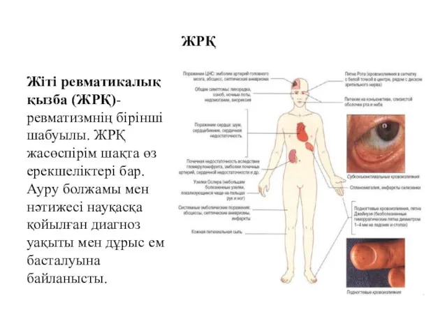 ЖРҚ Жіті ревматикалық қызба (ЖРҚ)- ревматизмнің бірінші шабуылы. ЖРҚ жасөспірім