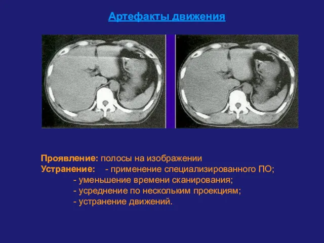 Артефакты движения Проявление: полосы на изображении Устранение: - применение специализированного