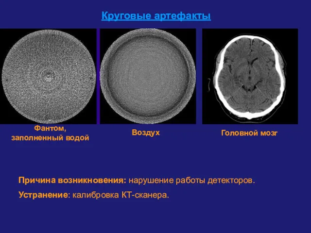 Круговые артефакты Причина возникновения: нарушение работы детекторов. Устранение: калибровка КТ-сканера. Фантом, заполненный водой Воздух Головной мозг