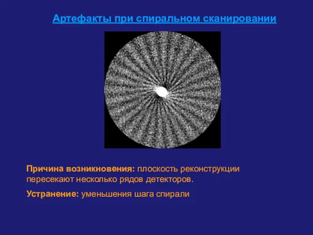 Артефакты при спиральном сканировании Причина возникновения: плоскость реконструкции пересекают несколько рядов детекторов. Устранение: уменьшения шага спирали