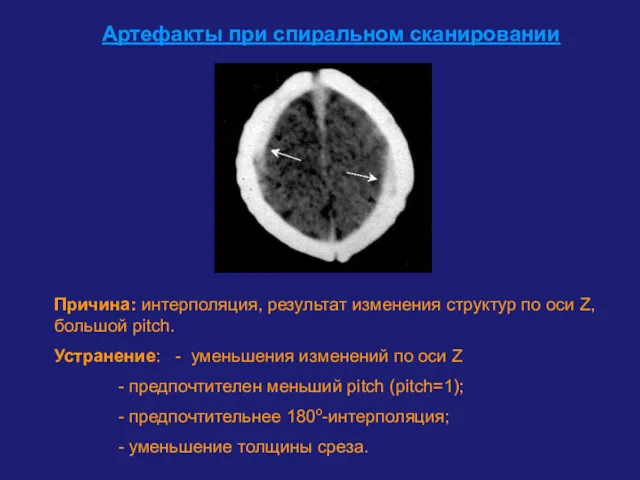 Артефакты при спиральном сканировании Причина: интерполяция, результат изменения структур по