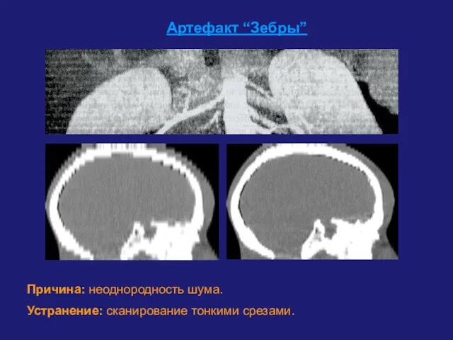 Артефакт “Зебры” Причина: неоднородность шума. Устранение: сканирование тонкими срезами.