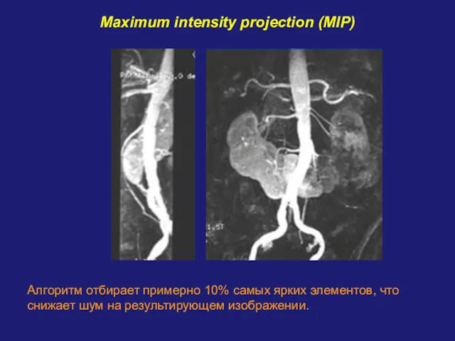 Maximum intensity projection (MIP) Алгоритм отбирает примерно 10% самых ярких