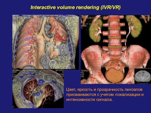 Interactive volume rendering (IVR/VR) Цвет, яркость и прозрачность пикселов присваиваются с учетом локализации и интенсивности сигнала.