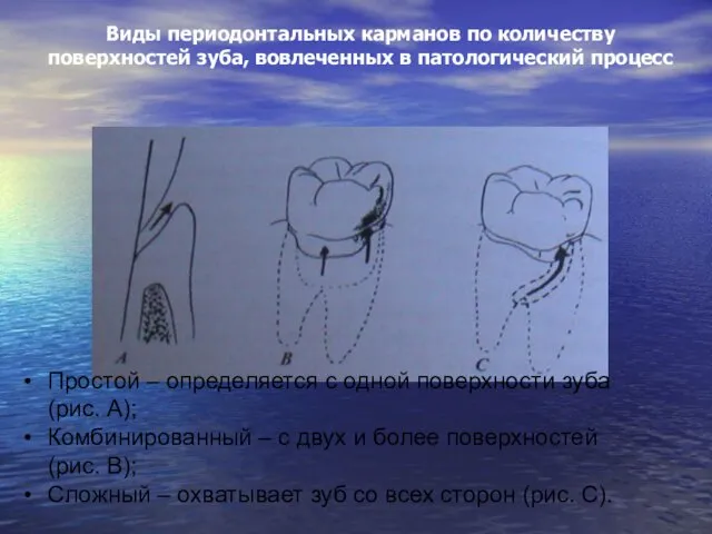 Виды периодонтальных карманов по количеству поверхностей зуба, вовлеченных в патологический