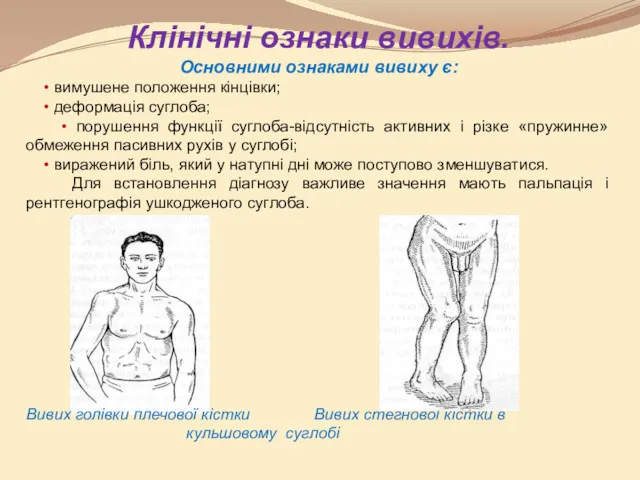 Клінічні ознаки вивихів. Основними ознаками вивиху є: • вимушене положення