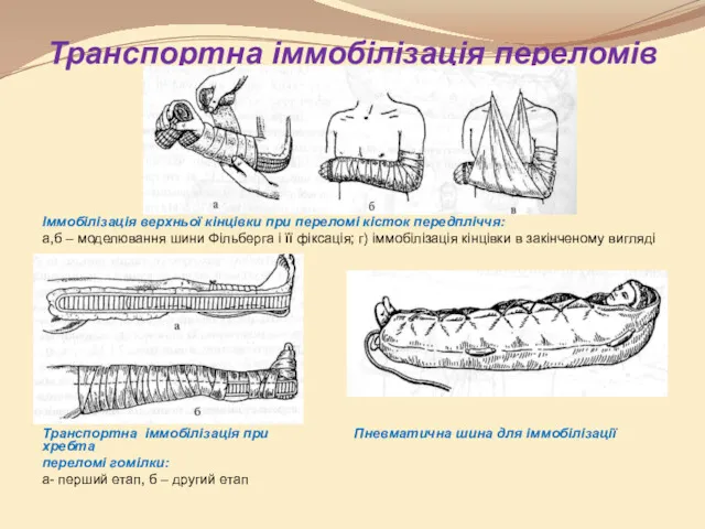 Транспортна іммобілізація переломів Іммобілізація верхньої кінцівки при переломі кісток передпліччя: