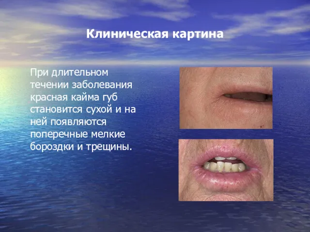 Клиническая картина При длительном течении заболевания красная кайма губ становится