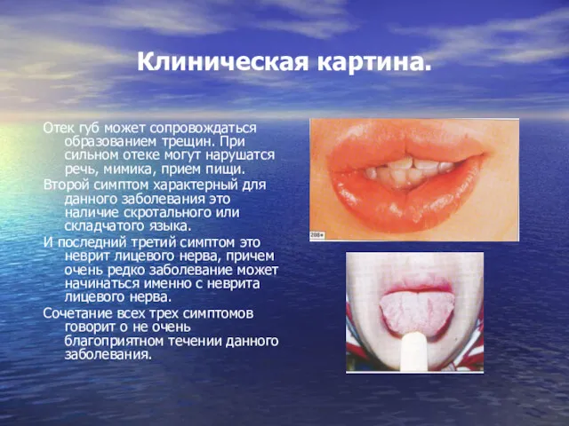 Клиническая картина. Отек губ может сопровождаться образованием трещин. При сильном