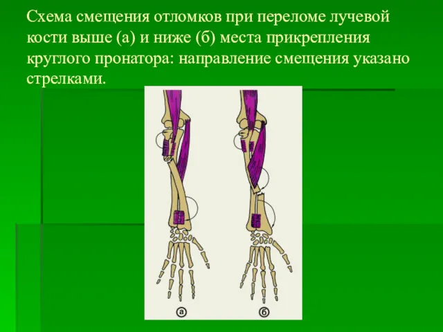Схема смещения отломков при переломе лучевой кости выше (а) и