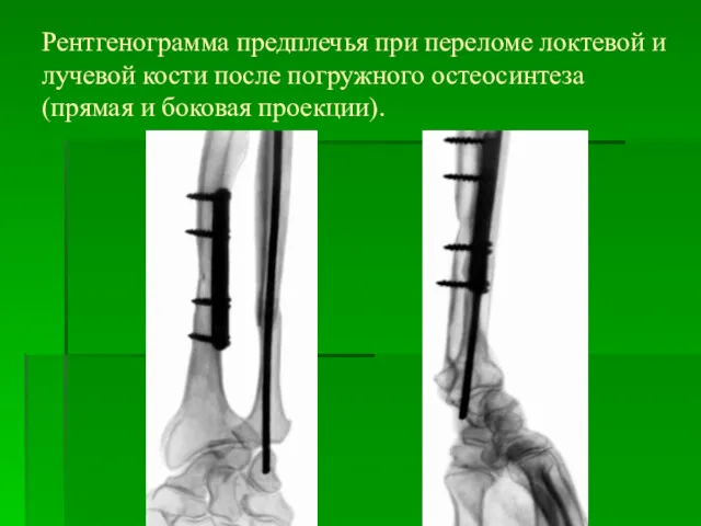 Рентгенограмма предплечья при переломе локтевой и лучевой кости после погружного остеосинтеза (прямая и боковая проекции).