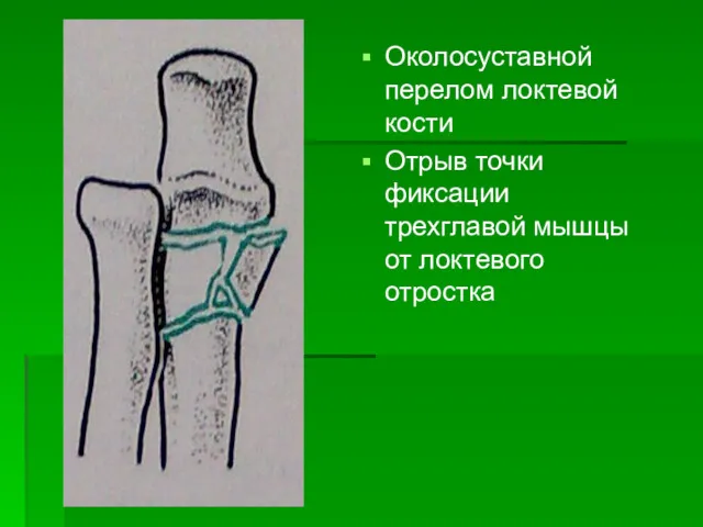 Околосуставной перелом локтевой кости Отрыв точки фиксации трехглавой мышцы от локтевого отростка