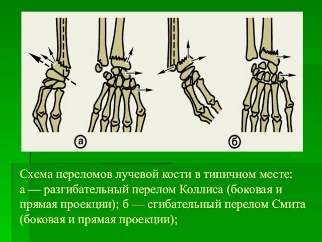 Схема переломов лучевой кости в типичном месте: а — разгибательный