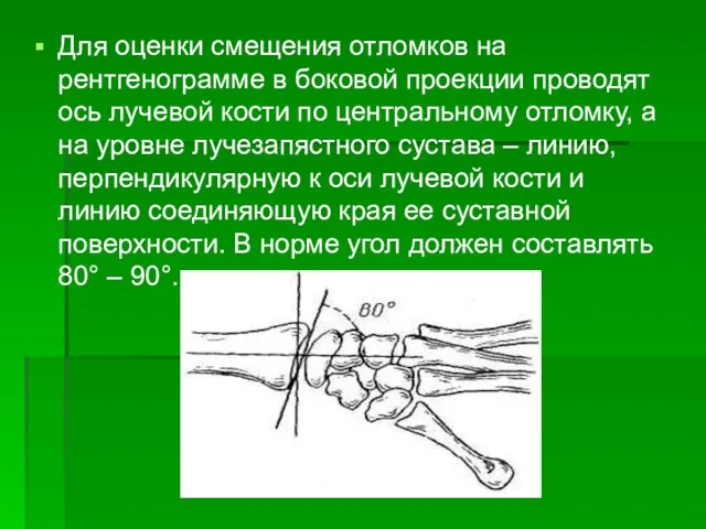 Для оценки смещения отломков на рентгенограмме в боковой проекции проводят