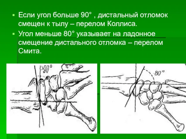 Если угол больше 90° , дистальный отломок смещен к тылу