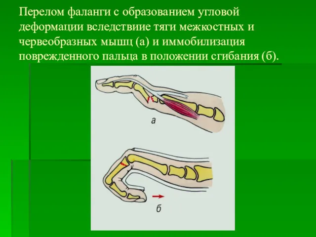 Перелом фаланги с образованием угловой деформации вследствиие тяги межкостных и