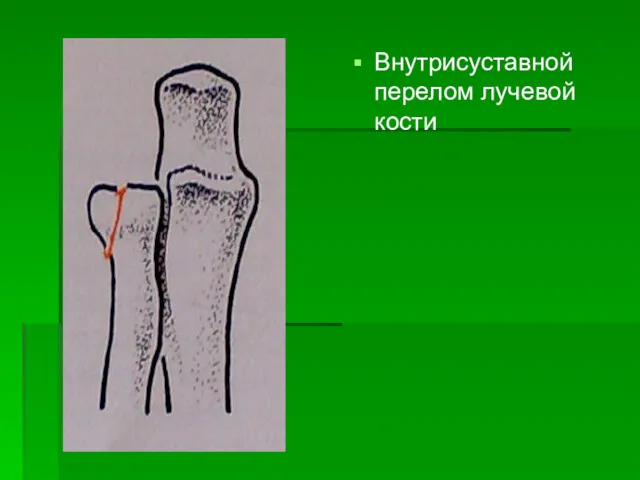 Внутрисуставной перелом лучевой кости