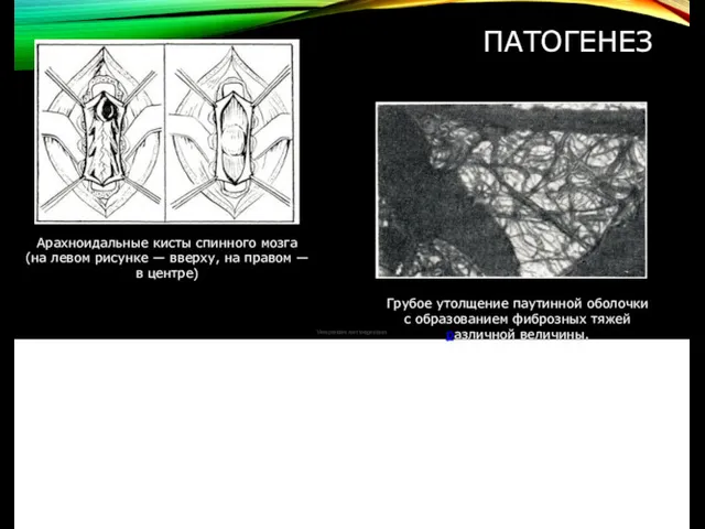 ПАТОГЕНЕЗ Арахноидальные кисты спинного мозга (на левом рисунке — вверху,