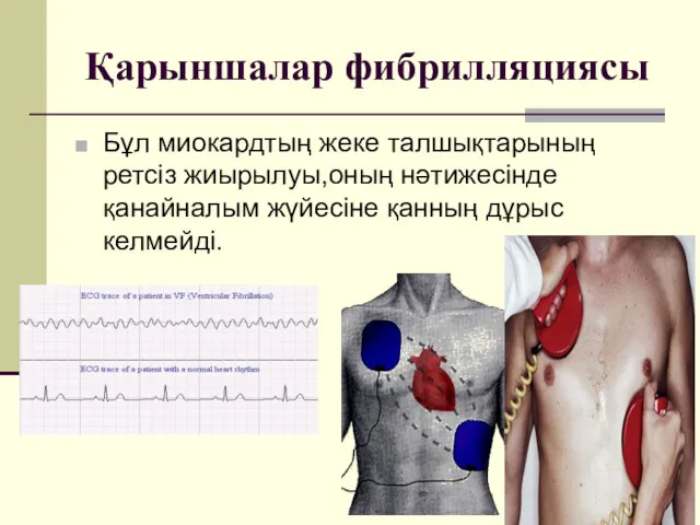 Қарыншалар фибрилляциясы Бұл миокардтың жеке талшықтарының ретсіз жиырылуы,оның нәтижесінде қанайналым жүйесіне қанның дұрыс келмейді.