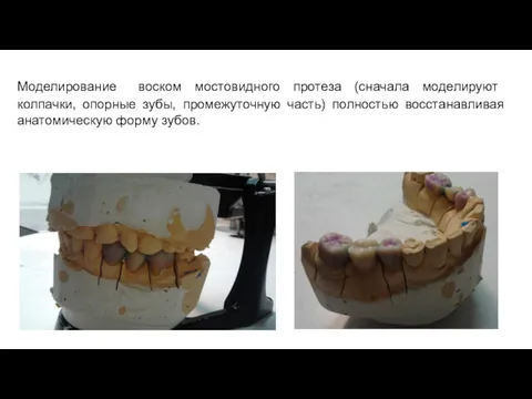 Моделирование воском мостовидного протеза (сначала моделируют колпачки, опорные зубы, промежуточную часть) полностью восстанавливая анатомическую форму зубов.