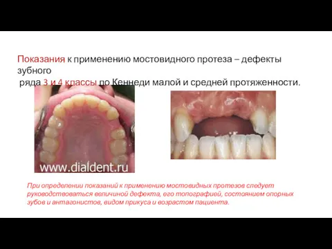 Показания к применению мостовидного протеза – дефекты зубного ряда 3