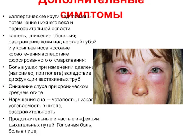 Дополнительные симптомы «аллергические круги под глазами» - потемнение нижнего века