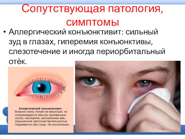 Сопутствующая патология, симптомы Аллергический конъюнктивит: сильный зуд в глазах, гиперемия конъюнктивы, слезотечение и иногда периорбитальный отѐк.