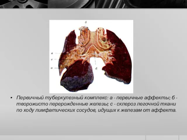 Первичный туберкулезный комплекс: а - первичные аффекты; б - творожисто