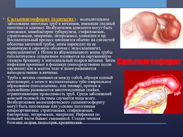 Сальпингоофорит Сальпингоофорит (аднексит) - воспалительное заболевание маточных труб и яичников,