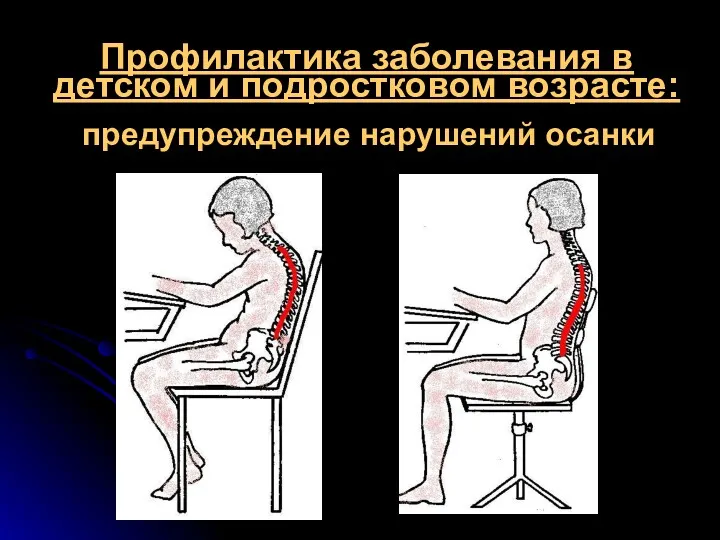 Профилактика заболевания в детском и подростковом возрасте: предупреждение нарушений осанки