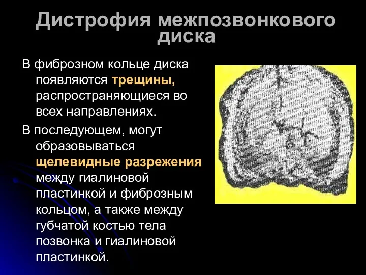 Дистрофия межпозвонкового диска В фиброзном кольце диска появляются трещины, распространяющиеся