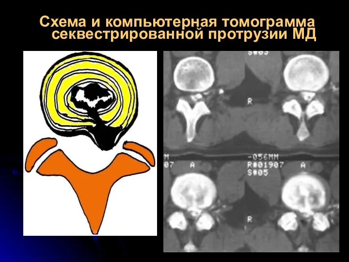 Схема и компьютерная томограмма секвестрированной протрузии МД