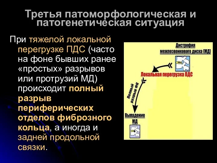 Третья патоморфологическая и патогенетическая ситуация При тяжелой локальной перегрузке ПДС