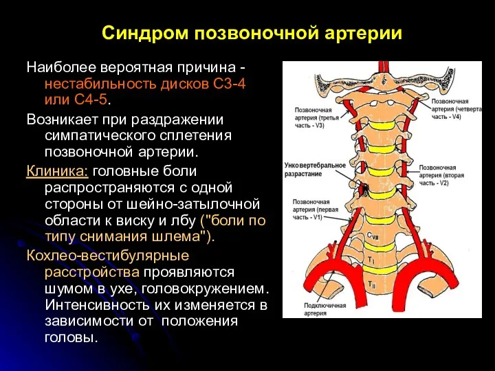 Синдром позвоночной артерии Наиболее вероятная причина - нестабильность дисков С3-4