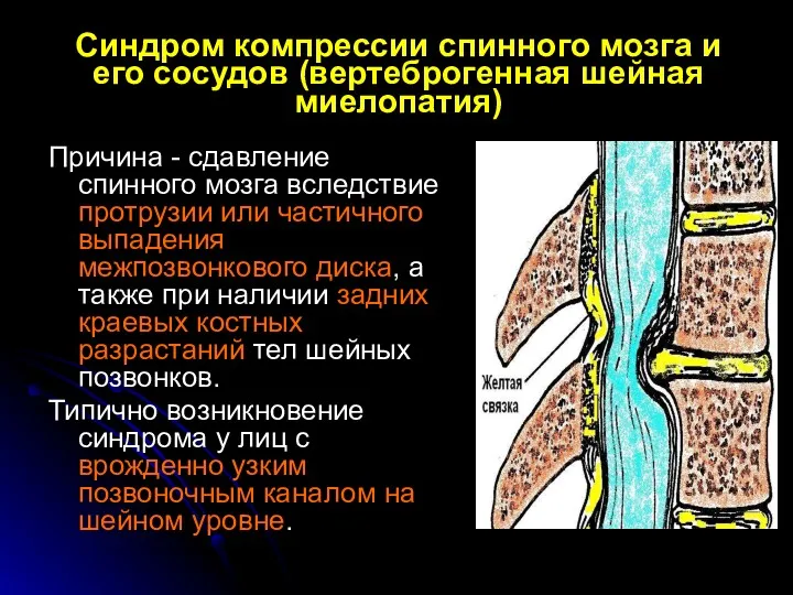 Синдром компрессии спинного мозга и его сосудов (вертеброгенная шейная миелопатия)