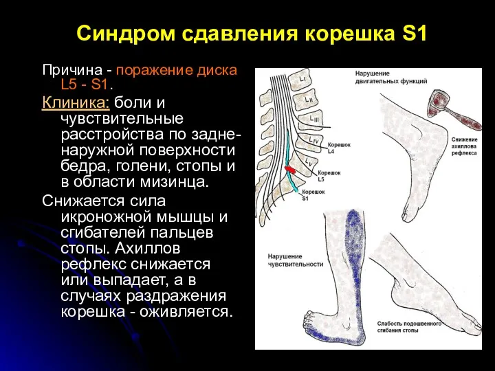 Синдром сдавления корешка S1 Причина - поражение диска L5 -