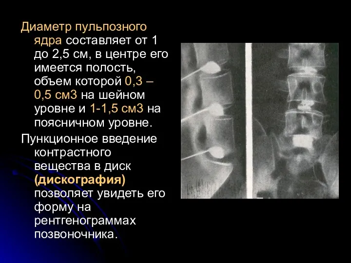 Диаметр пульпозного ядра составляет от 1 до 2,5 см, в