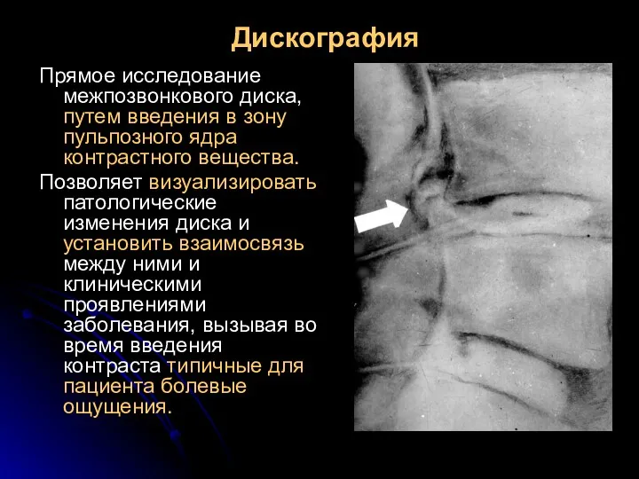 Дискография Прямое исследование межпозвонкового диска, путем введения в зону пульпозного