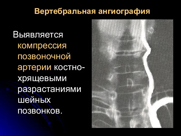 Вертебральная ангиография Выявляется компрессия позвоночной артерии костно-хрящевыми разрастаниями шейных позвонков.